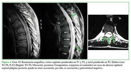 Caso 10. Resonancia magnética, cortes
sagitales ponderados en T1 y T2, y axial ponderado en T2. Define como T4-T8, P,
C2 (Región: T4-T8, Ubicación: posterior; Compromiso: comprime el contenido) en
casos de absceso epidural espinal piógeno posterior puede no tener asociación,
por ello, es asociación y perivertebral negativo.