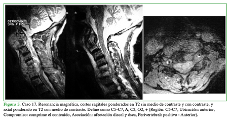 Caso 17. Resonancia magnética, cortes
sagitales ponderados en T2 sin medio de contraste y con contraste, y axial
ponderado en T2 con medio de contraste. Define como C5-C7, A, C2, O2, +
(Región: C5-C7, Ubicación: anterior, Compromiso: comprime el contenido,
Asociación: afectación discal y ósea, Perivertebral: positivo - Anterior).