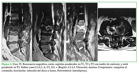 Caso 35. Resonancia magnética, cortes
sagitales ponderados en T1, T2 y T2 con medio de contraste, y axial ponderado
en T2. Define como L2-L3, A, C2, O2, + (Región: L2-L3, Ubicación: anterior,
Compromiso: comprime el contenido, Asociación: infección del disco y hueso,
Perivertebral: lateral/psoas).