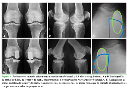 Paciente con prótesis
unicompartimental interna bilateral y 6.3 años de seguimiento. A y B. Radiografías de ambas rodillas,
de frente y de perfil, preoperatorias. Se observa genu varo artrósico
bilateral. C-F. Radiografías de
ambas rodillas, de frente y de perfil, y axial de rótula, posoperatorias. Se
puede visualizar la correcta alineación de los componentes en todas las
proyecciones.
