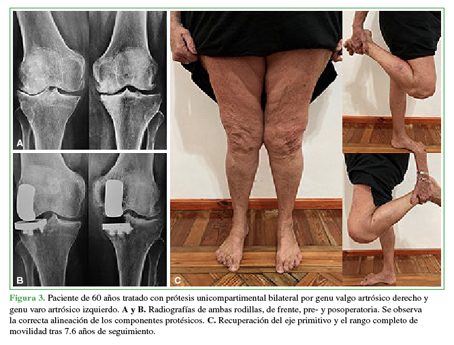 Paciente de 60 años tratado con
prótesis unicompartimental bilateral por genu valgo artrósico derecho y genu
varo artrósico izquierdo. A y B.
Radiografías de ambas rodillas, de frente, pre- y posoperatoria. Se observa la
correcta alineación de los componentes protésicos. C. Recuperación del eje primitivo y el rango completo de movilidad
tras 7.6 años de seguimiento.