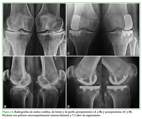 Radiografías de ambas rodillas, de
frente y de perfil, preoperatorias (A y
B) y posoperatorias (C y D). Paciente con prótesis unicompartimental externa
bilateral y 7.2 años de seguimiento. 

 