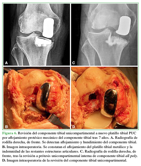 Revisión del componente tibial
unicompartimental a nuevo platillo tibial PUC por aflojamiento protésico mecánico del componente tibial tras 7 años. A. Radiografía de rodilla derecha,
de frente. Se detectan aflojamiento y hundimiento del componente tibial. B. Imagen intraoperatoria. Se constatan
el aflojamiento del platillo tibial metálico y la indemnidad de las restantes estructuras articulares. C. Radiografía de rodilla derecha, de
frente, tras la revisión a prótesis unicompartimental interna de componente
tibial all poly. D. Imagen intraoperatoria de la revisión del componente tibial
unicompartimental.