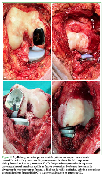 A y B. Imágenes intraoperatorias de la prótesis unicompartimental medial
con rodilla en flexión y extensión. Se puede observar la alineación del
componente tibial y femoral en flexión y extensión. C y D. Imágenes intraoperatorias de la prótesis unicompartimental
lateral con rodilla en flexión y extensión. Se observa la orientación
divergente de los componentes femoral y tibial con la rodilla en flexión,
debido al mecanismo de atornillamiento femorotibial (C) y la correcta alineación en extensión (D).