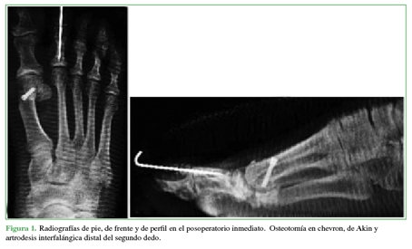 Radiografías de pie, de frente y de
perfil en el posoperatorio inmediato. Osteotomía en chevron, de Akin y artrodesis interfalángica distal del
segundo dedo.