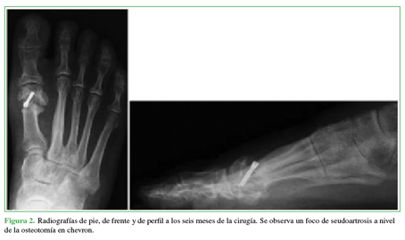 Radiografías de pie, de frente y de
perfil a los seis meses de la cirugía. Se observa un foco de seudoartrosis a
nivel de la osteotomía en chevron.