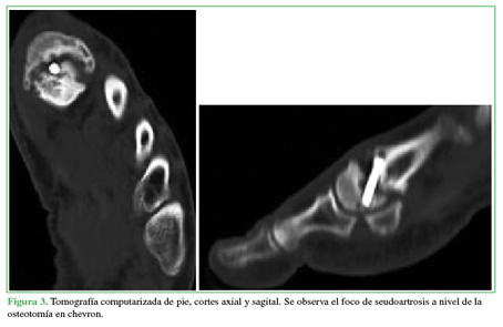 Tomografía computarizada de pie,
cortes axial y sagital. Se observa el foco de seudoartrosis a nivel de la
osteotomía en chevron.