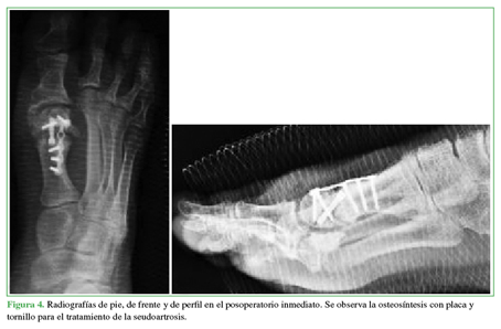Radiografías de pie, de frente y de
perfil en el posoperatorio inmediato. Se observa la osteosíntesis con placa y
tornillo para el tratamiento de la seudoartrosis.