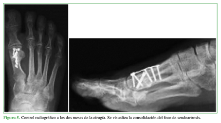 Control radiográfico a los dos meses de la cirugía. Se visualiza la
consolidación del foco de seudoartrosis.