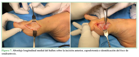 Abordaje longitudinal medial del
hallux sobre la incisión anterior, capsulotomía e identificación del foco de
seudoartrosis.