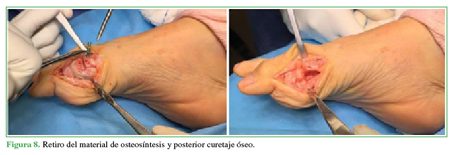Retiro del material de osteosíntesis y
posterior curetaje óseo.