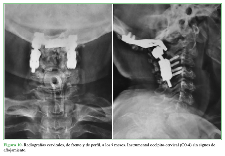 Radiografías cervicales, de frente y
de perfil, a los 9 meses. Instrumental occipito-cervical (C0-4) sin signos de
aflojamiento.