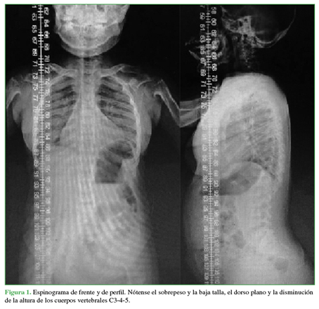 Espinograma de frente y de perfil.
Nótense el sobrepeso y la baja talla, el dorso plano y la disminución de la
altura de los cuerpos vertebrales C3-4-5.