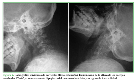 Radiografías dinámicas de cervicales
(flexo-extensión). Disminución de la altura de los cuerpos vertebrales C3-4-5,
con una aparente hipoplasia del proceso odontoides, sin signos de
inestabilidad.