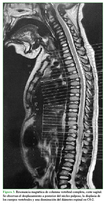 Resonancia magnética de columna
vertebral completa, corte sagital. Se observan el desplazamiento a posterior
del núcleo pulposo, la displasia de los cuerpos vertebrales y una disminución
del diámetro espinal en C0-2.