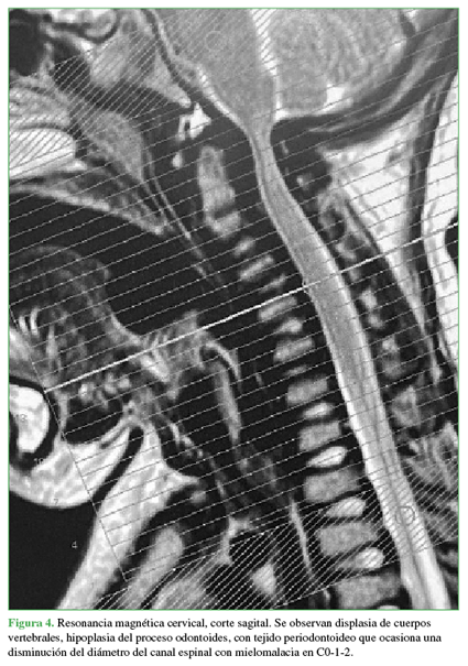 Resonancia magnética cervical, corte
sagital. Se observan displasia de cuerpos vertebrales, hipoplasia del proceso
odontoides, con tejido periodontoideo que ocasiona una disminución del diámetro
del canal espinal con mielomalacia en C0-1-2.