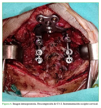 Imagen intraoperatoria. Descompresión
de C1-2. Instrumentación occipito-cervical.