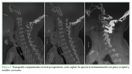 Tomografía computarizada cervical
posoperatoria, corte sagital. Se aprecia la instrumentación con placa occipital
y tornillos cervicales.