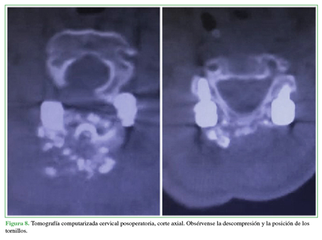 Tomografía computarizada cervical
posoperatoria, corte axial. Obsérvense la descompresión y la posición de los
tornillos.