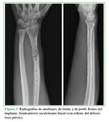 Radiograf&iacute;as de antebrazo, de frente y
de perfil. Retiro del implante. Seudoartrosis recalcitrante lineal (con relleno
del defecto &oacute;seo previo).