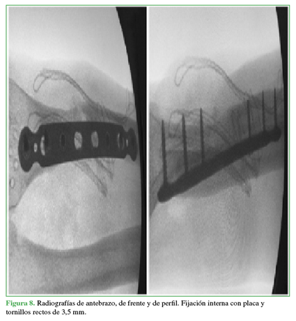 Radiograf&iacute;as de antebrazo, de frente y
de perfil. Fijaci&oacute;n interna con placa y tornillos rectos de 3,5 mm.