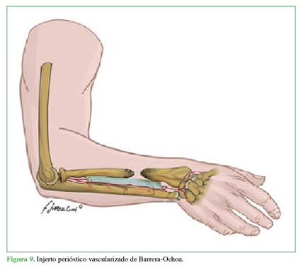 Injerto peri&oacute;stico vascularizado de
Barrera-Ochoa. 

 