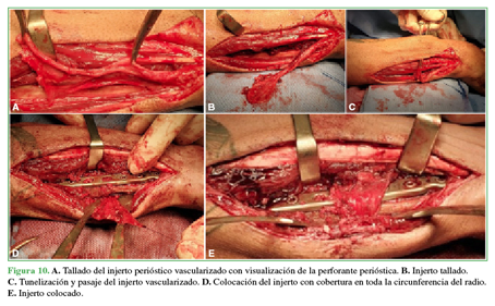 A. Tallado del injerto peri&oacute;stico vascularizado con visualizaci&oacute;n de
la perforante peri&oacute;stica. B. Injerto
tallado. C. Tunelizaci&oacute;n y pasaje del injerto vascularizado. D. Colocaci&oacute;n del injerto con cobertura en toda la circunferencia
del radio. E. Injerto colocado. 

 