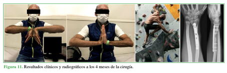 Resultados cl&iacute;nicos y radiogr&aacute;ficos a
los 4 meses de la cirug&iacute;a.