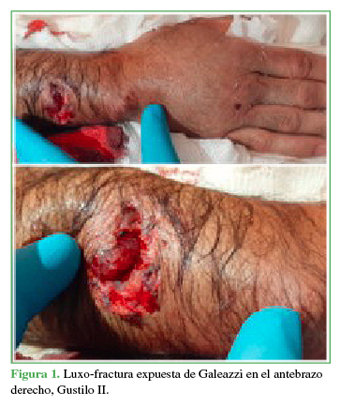 Luxo-fractura expuesta de Galeazzi en
el antebrazo derecho,
Gustilo II.