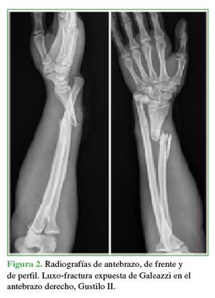 Radiograf&iacute;as de antebrazo, de frente y
de perfil. Luxo-fractura expuesta
de Galeazzi en el antebrazo derecho, Gustilo
II. 

 
