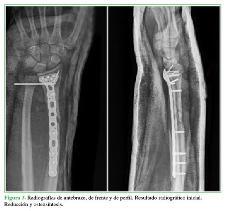 Radiograf&iacute;as de antebrazo, de frente y
de perfil. Resultado radiogr&aacute;fico
inicial. Reducci&oacute;n y osteos&iacute;ntesis. 

 
