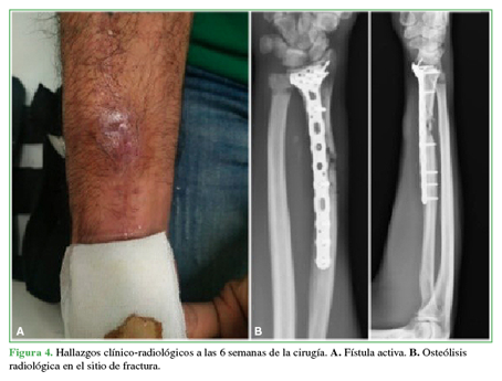 Hallazgos cl&iacute;nico-radiol&oacute;gicos a las 6 semanas de la cirug&iacute;a. A. F&iacute;stula activa. B. Oste&oacute;lisis radiol&oacute;gica en el sitio de la fractura.