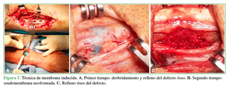 T&eacute;cnica de membrana inducida. A. Primer tiempo: desbridamiento y
relleno del defecto &oacute;seo. B. Segundo
tiempo: seudomembrana neoformada. C. Relleno &oacute;seo del defecto.
