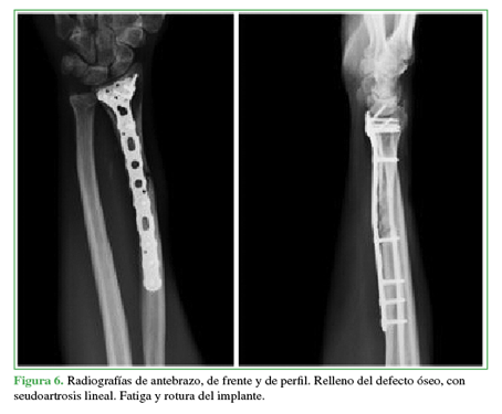 Radiograf&iacute;as de antebrazo, de frente y
de perfil. Relleno del defecto &oacute;seo, con seudoartrosis lineal. Fatiga y rotura
del implante. 

 

 