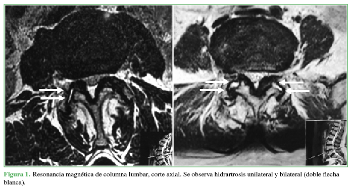 Resonancia magnética de columna lumbar, corte axial. Se
observa hidrartrosis unilateral y bilateral (doble flecha blanca).