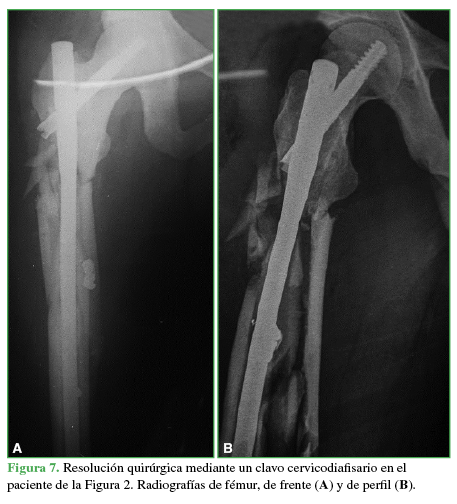  Resolución quirúrgica mediante un clavo cervicodiafisario en el paciente de la Figura 2.
Radiografías de fémur, de frente (A)
y de perfil (B).