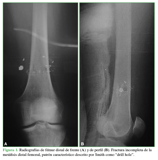 Radiografías de fémur distal de frente (A) y de perfil (B). Fractura incompleta de la metáfisis distal femoral, patrón
característico descrito por Smith como “drill hole”.