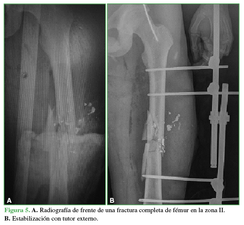 A.
Radiografía de frente de una fractura completa de fémur en la zona II. B. Estabilización con tutor
externo.