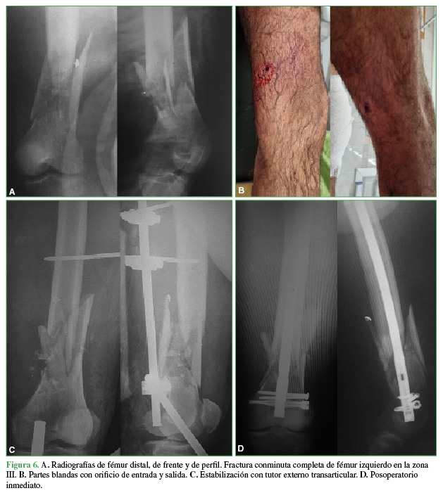 A.
Radiografías de fémur distal, de frente y de perfil. Fractura conminuta
completa de fémur izquierdo en la zona III. B. Partes
blandas con orificio de entrada y salida. C.
Estabilización con tutor externo transarticular. D. Posoperatorio inmediato.