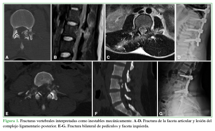 Fracturas vertebrales interpretadas como inestables mecánicamente. A-D. Fractura de la faceta articular y lesión del complejo ligamentario posterior. E-G. Fractura bilateral de pedículos y faceta izquierda.