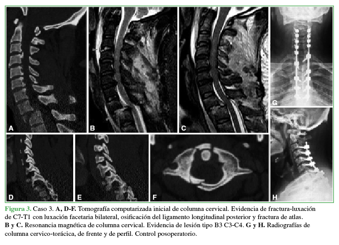 Caso 3. A, D-F.
Tomografía computarizada inicial de columna cervical. Evidencia de
fractura-luxación de C7-T1 con luxación facetaria bilateral, osificación del
ligamento longitudinal posterior y fractura de atlas. B y C. Resonancia
magnética de columna cervical. Evidencia de lesión tipo B3 C3-C4. G y H. Radiografías de columna cervico-torácica, de frente y de perfil. Control
posoperatorio.