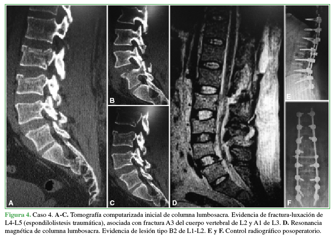 Caso 4. A-C.
Tomografía computarizada inicial de columna lumbosacra. Evidencia de
fractura-luxación de L4-L5 (espondilolistesis traumática), asociada con
fractura A3 del cuerpo vertebral de L2 y A1 de L3. D. Resonancia magnética de columna lumbosacra. Evidencia de lesión
tipo B2 de L1-L2. E y F. Control
radiográfico posoperatorio.