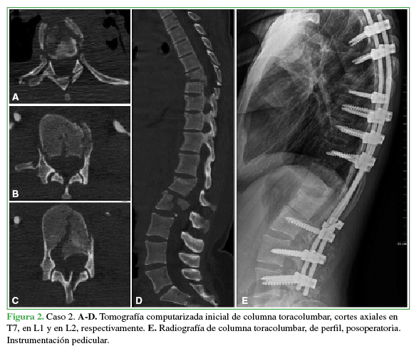 Caso 2. A-D.
Tomografía computarizada inicial de columna toracolumbar, cortes axiales en T7, en L1 y
en L2, respectivamente. E.
Radiografía de columna toracolumbar, de perfil, posoperatoria. Instrumentación pedicular.