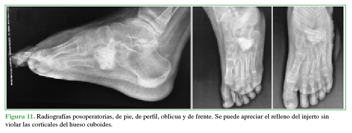 Radiografías posoperatorias, de pie, de perfil, oblicua
y de frente. Se puede apreciar el relleno del injerto sin violar las corticales
del hueso cuboides.