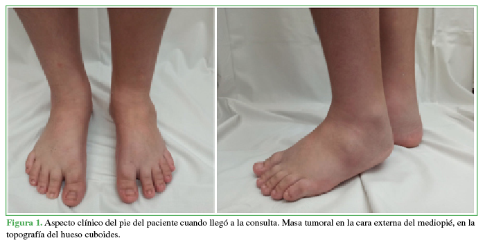 Aspecto clínico del pie del
paciente cuando llegó a la consulta. Masa tumoral en la cara externa del mediopié, en la topografía del hueso cuboides.