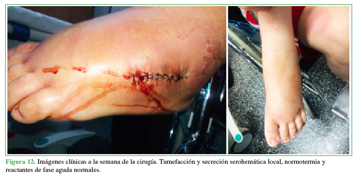 Imágenes clínicas a la semana de la cirugía. Tumefacción
y secreción serohemática local, normotermia y
reactantes de fase aguda normales.