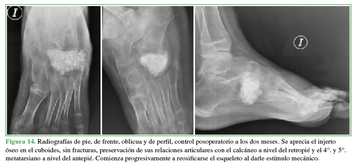Radiografías de pie, de frente, oblicua y de perfil,
control posoperatorio a los dos meses. Se aprecia el injerto óseo en el
cuboides, sin fracturas, preservación de sus relaciones articulares con el
calcáneo a nivel del retropié y el 4°. y 5°. metatarsiano a nivel del antepié.
Comienza progresivamente a reosificarse el esqueleto
al darle estímulo mecánico.