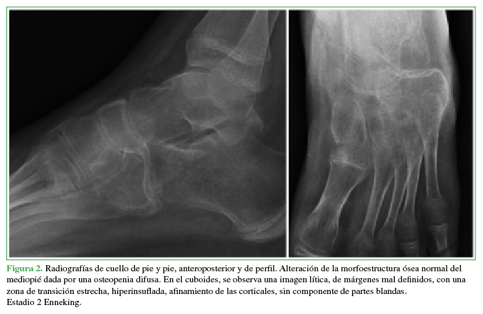 Radiografías de cuello de pie y pie, anteroposterior y
de perfil. Alteración de la morfoestructura ósea normal del mediopié
dada por una osteopenia difusa. En el cuboides, se observa una imagen lítica, de márgenes mal definidos, con una zona de transición estrecha, hiperinsuflada,
afinamiento de las corticales, sin componente de partes blandas. Estadio 2 Enneking.