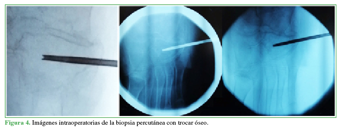 Imágenes intraoperatorias de la biopsia percutánea con
trocar óseo.
