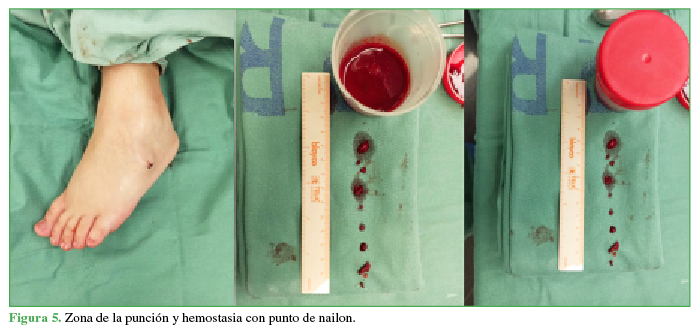 Zona de la punción y hemostasia con punto de nailon.